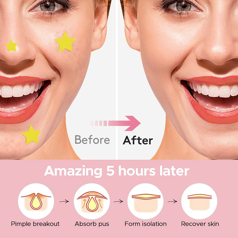 600 ชิ้น/เซ็ต Star Pimple Patc - Beauty Makeup Tools Set บทวิจารณ์และราคา